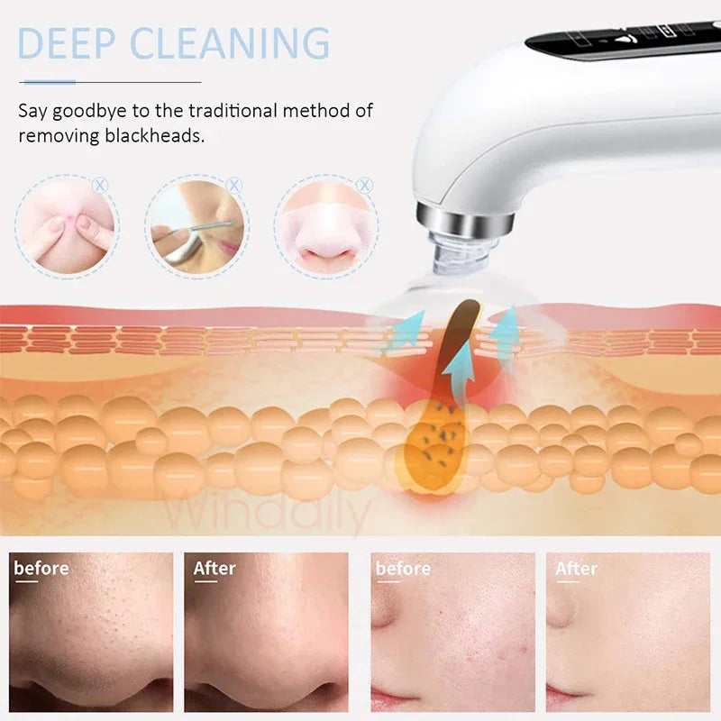 Emeka Black Head Remover Pore Vacuum Cleaner Electric Micro Small Bubble Facial Cleasing Machine USB Rechargeable Beauty Device